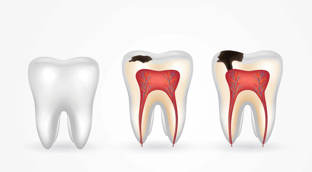 Dental Clinic in Sector 91, Gurgaon: Class V Fillings for Cavities Near the Gum Line