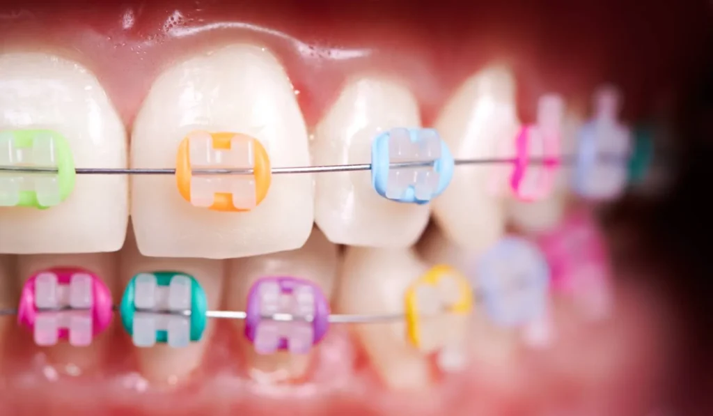 Dental Clinic in Sector 95 Gurgaon: How to Choose the Right Braces Color