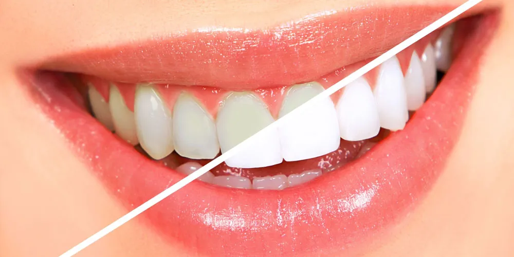 Best Dental Clinic Near Me for Teeth Whitening in Sector 90, Gurgaon