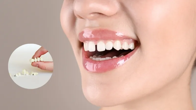 Teeth Cap Price in India: Types of Dental Crowns, Cost & What to Expect